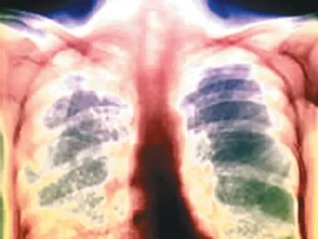 Tuberculosis es principal causa de muerte de personas que tienen VIH