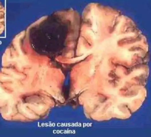 Detectan anomalías en el cerebro de los consumidores de cocaína