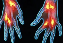 Ideas de suicidio son más comunes en enfermos de artritis