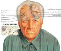 En Francia expusieron los factores que se tienen que prevenir para evitar el Alzheimer