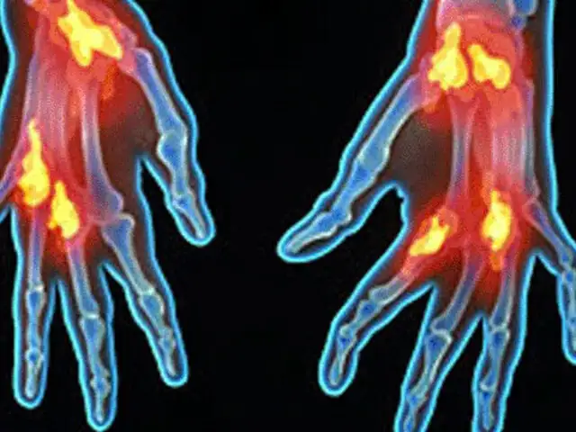 Ideas de suicidio son más comunes en enfermos de artritis