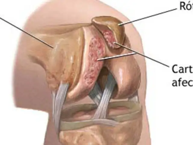 Pacientes con problemas de rodilla no traumáticos desarrollan males crónicos