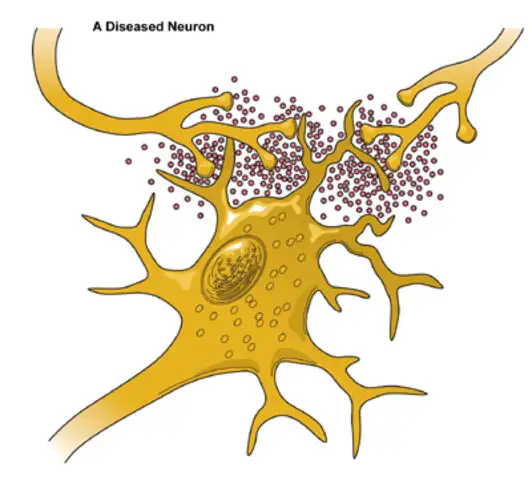 Con el uso de los neuroprotectores se podría prevenir el mal de Parkinson