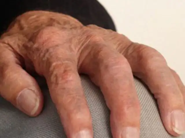Gracias a la tecnología genómica descubren se despejan incógnitas sobre la artritis reumatoide