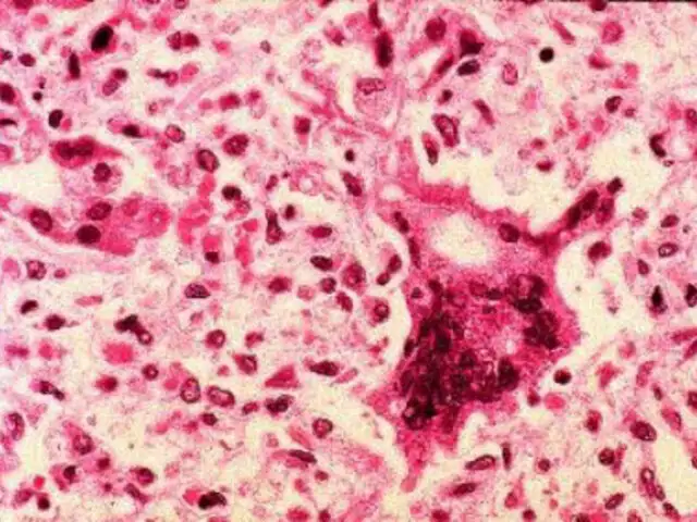 Científicos señalan que el sarampión podría acabar con tumores cancerosos