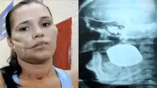 México: expertos desactivan con éxito una granada incrustada en el rostro de una mujer