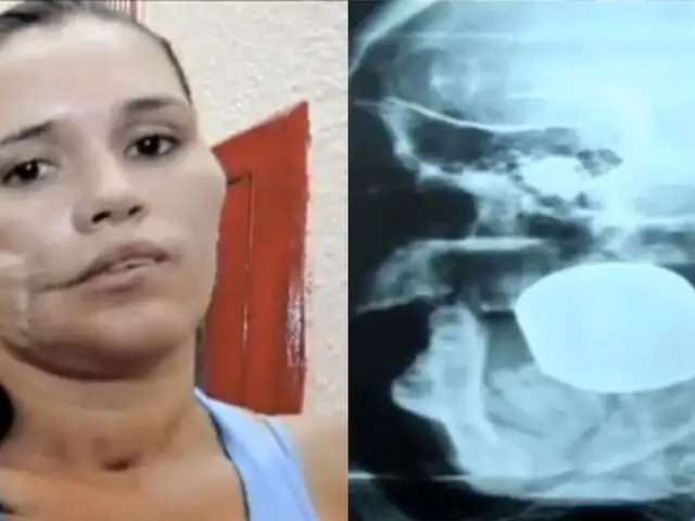 México: expertos desactivan con éxito una granada incrustada en el rostro de una mujer