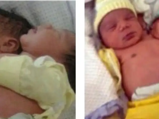 Nacimiento de gemelos siameses causa conmoción en Brasil