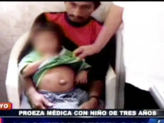 Chiclayo: Le quitan feto parásito del abdomen a niño de tres años 