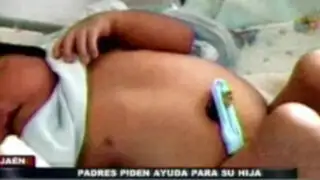 Jaén: padres piden ayuda para bebé que nació con extraña malformación
