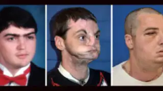 EEUU: realizan trasplante de rostro más completo de la historia