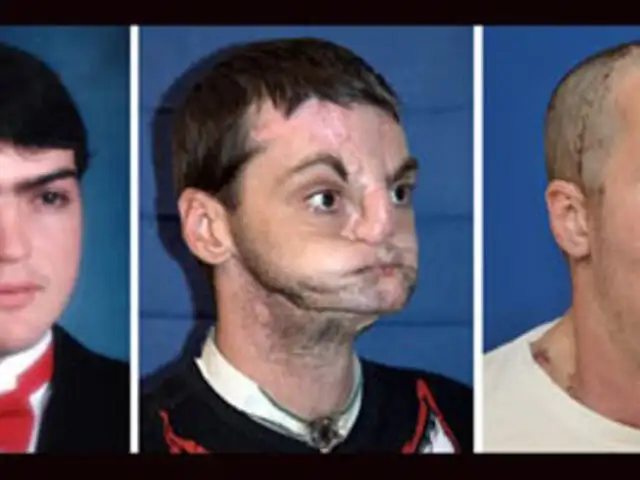 EEUU: realizan trasplante de rostro más completo de la historia