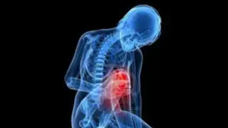 La osteoporosis: conozca sus síntomas, diagnóstico y tratamiento