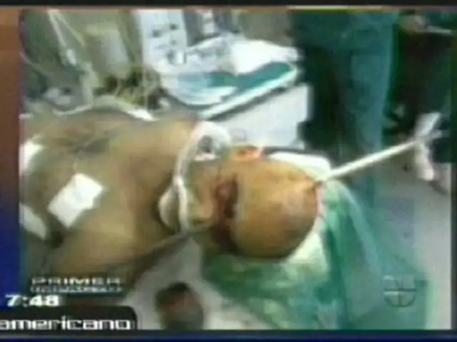 Brasil: barra de acero perfora cráneo de sujeto y sobrevive milagrosamente