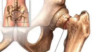 Científicos desarrollan una prótesis de cadera que podría durar toda la vida