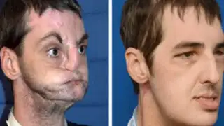Hombre sometido a trasplante de rostro se recupera soprendentemente