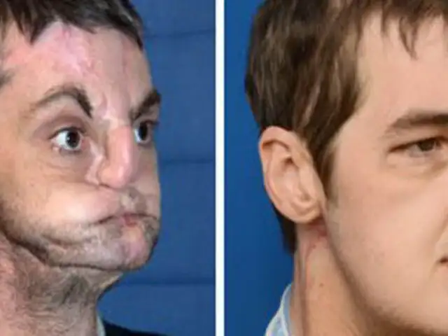 Hombre sometido a trasplante de rostro se recupera soprendentemente