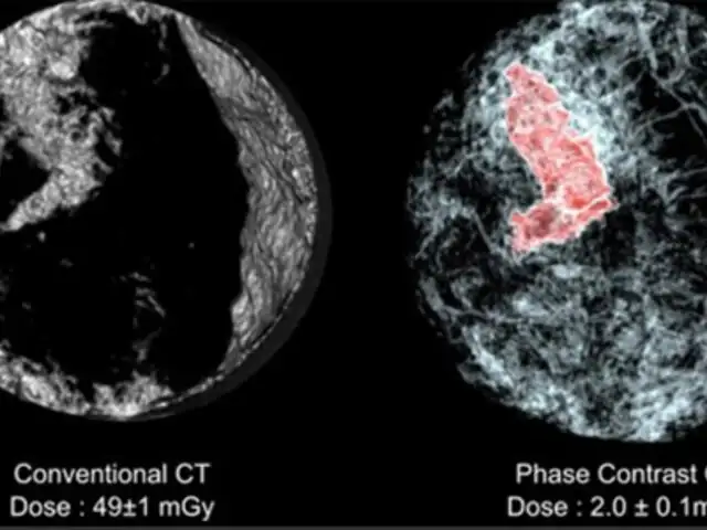 Cáncer de mama podrá ser detectado en escáner de tres dimensiones