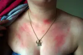 ¡Cuidado! Uno de cada tres peruanos sufre de alergias