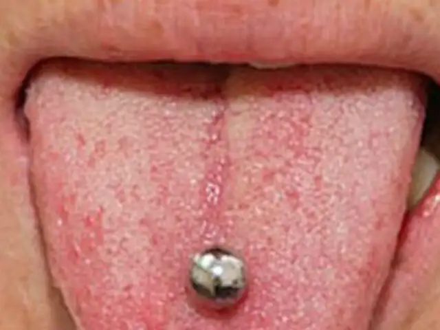 Reino Unido: joyas magnéticas en la lengua ponen en peligro a adolescentes