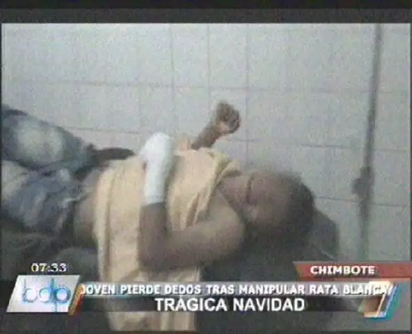 Chimbote: joven perdió cuadro dedos al manipular “Rata Blanca”