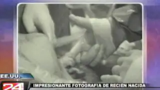 Sorprendente imagen de bebé que agarra el dedo de su médico al nacer