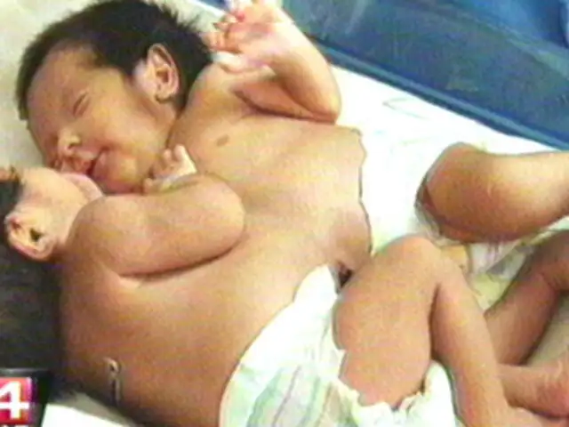 Médicos aseguran que se podrá separar a siamesas recién nacidas