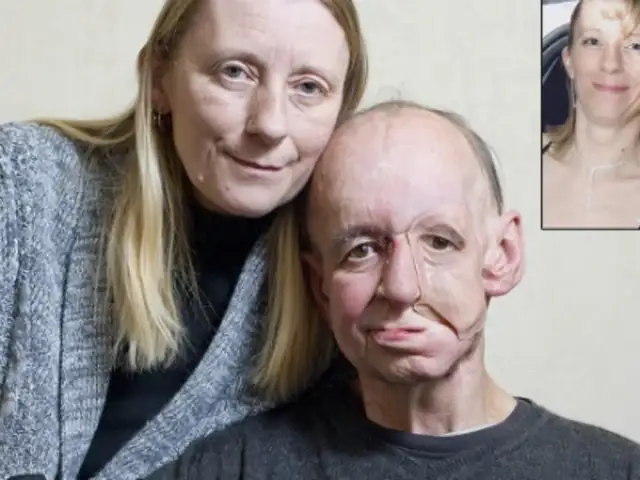 Reino Unido: médicos logran reconstruir parte de un rostro con impresora 3D