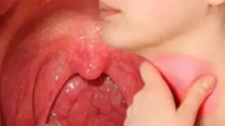 Soluciones médicas: Dolencias en la garganta podrían llegar a causar cáncer