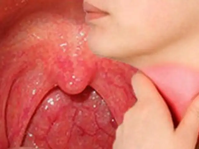 Soluciones médicas: Dolencias en la garganta podrían llegar a causar cáncer