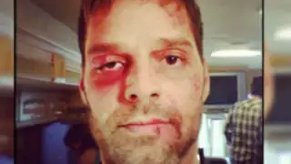 EEUU: Ricky Martin sorprende a fanáticos con foto de su rostro golpeado