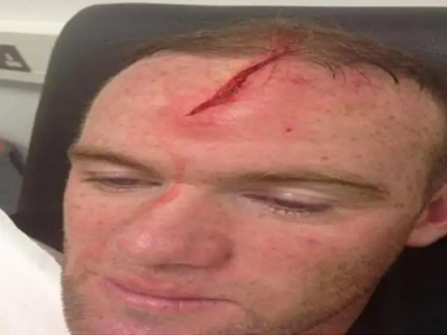 Wayne Rooney sufrió un terrible corte en la cabeza tras chocar con su compañero