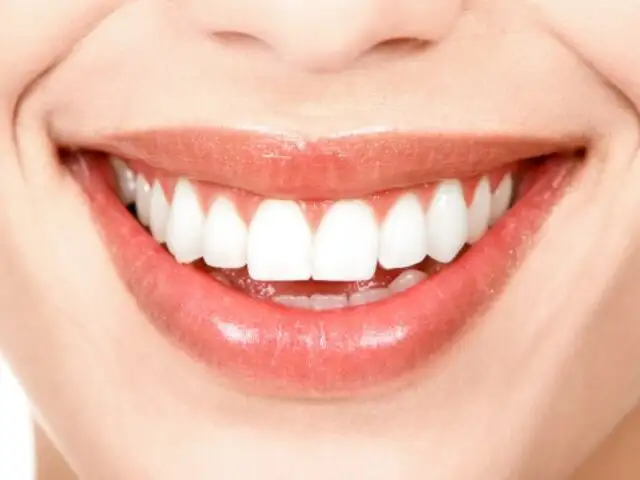 Salud Dental: conoce el adecuado procedimiento de las carillas de porcelana