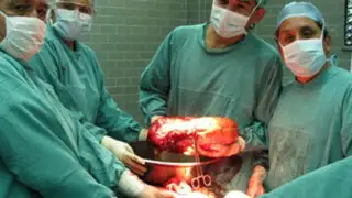 Médicos de EsSalud salvan vida de mujer tras extirparle tumor gigante
