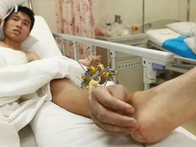 Proeza médica en China: le implantan su mano en el tobillo para salvarle la vida