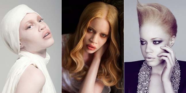 Modelo negra albina emprende lucha contra la...