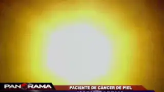 Peligro bajo el sol: el cáncer a la piel amenaza a los peruanos