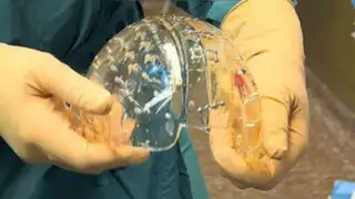 Implantan cráneo de plástico hecho con impresora 3D a una joven holandesa