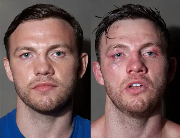 Estremecedores cambios: el antes y después de los boxeadores tras una pelea