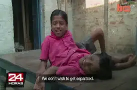 India: siameses conmueven al mundo porque se niegan a ser separados