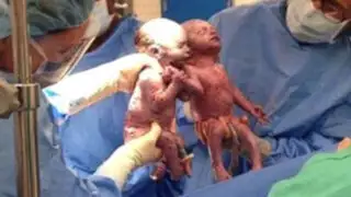 Estados Unidos: gemelas sorprenden al mundo al nacer tomadas de las manos