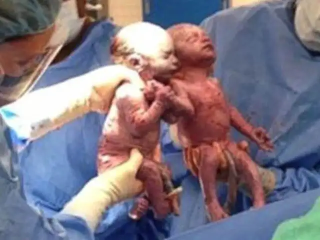 Estados Unidos: gemelas sorprenden al mundo al nacer tomadas de las manos