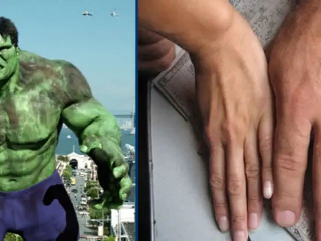 El increíble Hulk existe en la vida real y tiene las manos más grandes del mundo