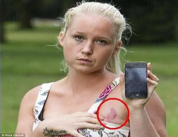 Reino Unido: joven sufre quemadura tras incendiarse su iPhone
