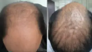 Recupere su cabello con novedosa técnica de estimulación por plasma
