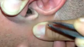 VIDEO: ¡Le quitan a un hombre un enorme insecto del oído!