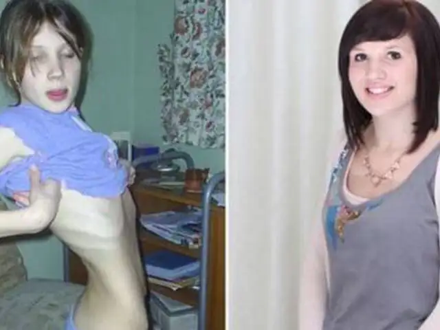 FOTOS: 15 impactantes transformaciones de personas que vencieron a la anorexia