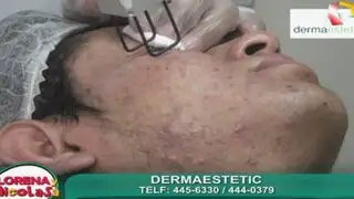 Hágase un tratamiento láser en el rostro para solucionar el problema del acné