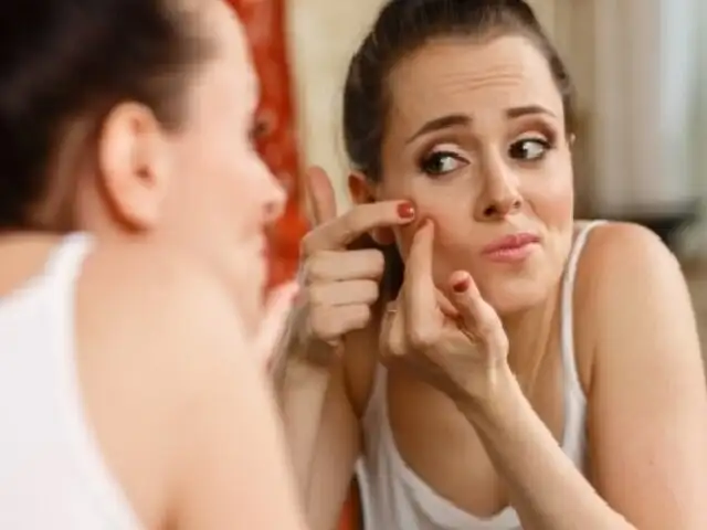 FOTOS: conoce estos 4 tips sencillos para eliminar el acné