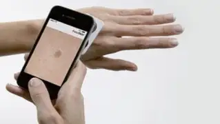 Tendencias en Línea: esta App podría diagnosticar si tienes cáncer de piel